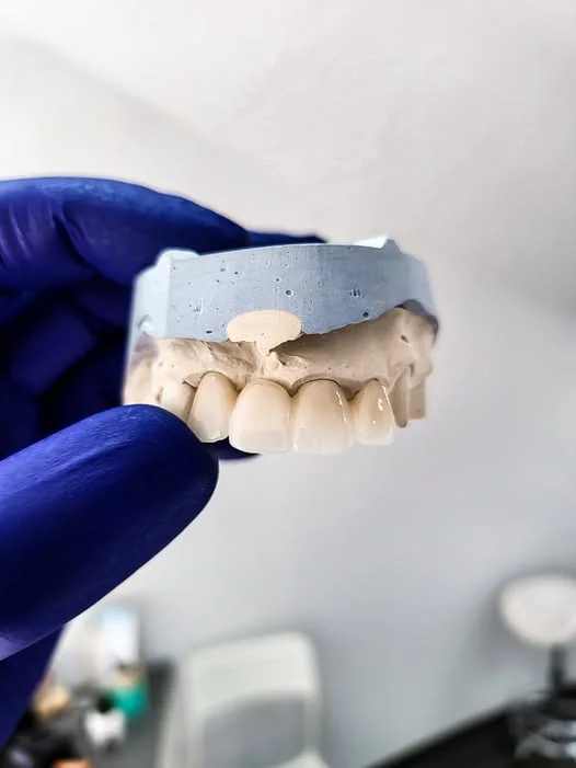 Lucrare protetică probată pe model